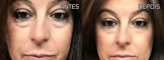 Antes e depois apresentado na página Remove Japan